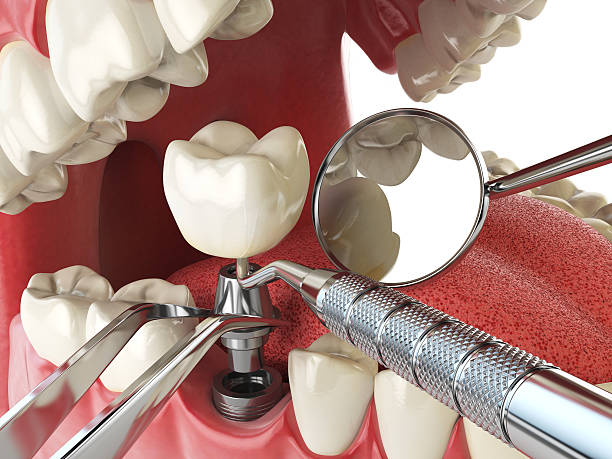 Best Emergency Tooth Extraction in Lake Ripley, WI